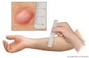 Measurement of a <b>Tuberculin</b>