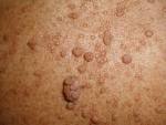 <b>Neurofibromas</b>