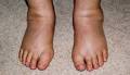 Oedema - Definition - NHS Choices