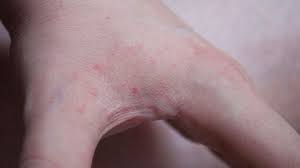 Image result for bed bug bites