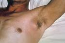 Lesson 2-2 Axillary Bubo