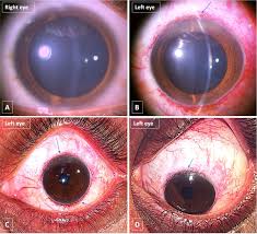 Kuvahaun tulos haulle Kayser-Fleischer