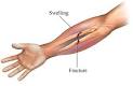 Forearm Fracture - Anytime Health