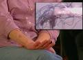 morgellons disease picture