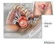 Ovarian Cysts: What You Need to Know about an Ovarian Cyst and PCOS