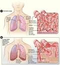 Idiopathic <b>Pulmonary Fibrosis</b>