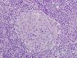 Granuloma - Wikipedia, the free encyclopedia