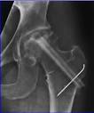 <b>de la cabeza femoral</b>.