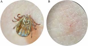 Attēlu rezultāti vaicājumam “Dermacentor reticulatus”