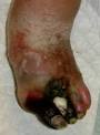 Diabetic Foot Ulcers | Wound Care | Education