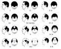 Hair Foundation Article - Hair Loss and Its Causes