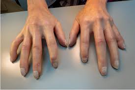 Attēlu rezultāti vaicājumam “Scleroderma”