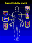 Amyloidosis Overview - Human Immunology and Cancer Program