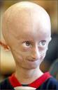 Progeria image