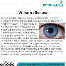 Kuvahaun tulos haulle Kayser-Fleischer