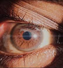 Kuvahaun tulos haulle Kayser-Fleischer