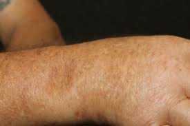 Attēlu rezultāti vaicājumam “Scleroderma”