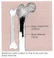 Bone Cancer - symptoms and