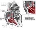 Tricuspid Regurgitation
