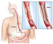 of esophageal cancer.