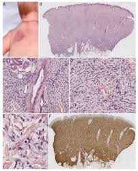 Attēlu rezultāti vaicājumam “Diderma chondrioderma sessile”