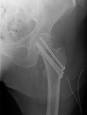 Hip fracture - Wikipedia, the free encyclopedia