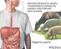 Brucellosis (Pictures, Images, Photos, &amp; Diagrams)