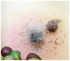 Attēlu rezultāti vaicājumam “Melanospora lagenaria”