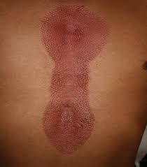 Attēlu rezultāti vaicājumam “Diderma chondrioderma sessile”