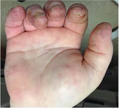 Attēlu rezultāti vaicājumam “Scleroderma”