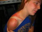 <b>Sunburn</b> 300x225 <b>Sunburn</b> (acute
