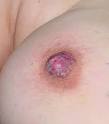 de <b>Paget mamaria</b>: Caso