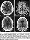 A <b>neurocisticercose</b> acomete