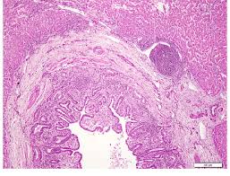Image result for cholangiectasis