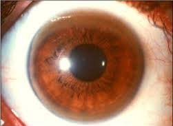 Kuvahaun tulos haulle Kayser-Fleischer