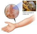 Symptoms of <b>scabies</b> include