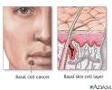 Is it a Benign Skin Lesion (Sun Spot, Liver Spot, Seborrheic ...