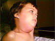 Child with <b>mumps</b>
