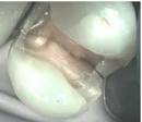 <b>Cracked Tooth Syndrome</b> | The