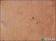 Blackheads (comedones): MedlinePlus Medical Encyclopedia Image