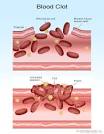 Blood Clots, Causes, Symptoms, Types, and Treatment on MedicineNet.