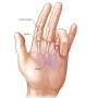 q=q%3Dhttps://www.mayoclinic.org/diseases-conditions/trigger-finger/diagnosis-treatment/drc-20365148 from www.allcaretherapygt.com