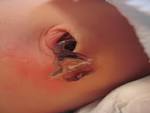 Toddler): <b>umbilical cord</b>