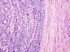 File:<b>Endometrial stromal</b>