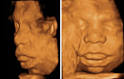 a mid-trimester fetus.