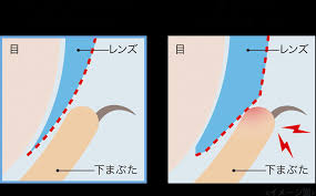 「ワンデーアキュビュートゥルーアイ　曇る」の画像検索結果