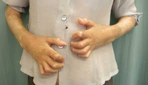 Attēlu rezultāti vaicājumam “Scleroderma”