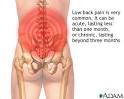 One type of <b>low back pain</b> is