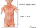 Signos de <b>escarlatina</b>