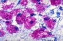<b>Infection</b>